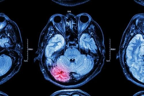 Understanding How Negligence Image